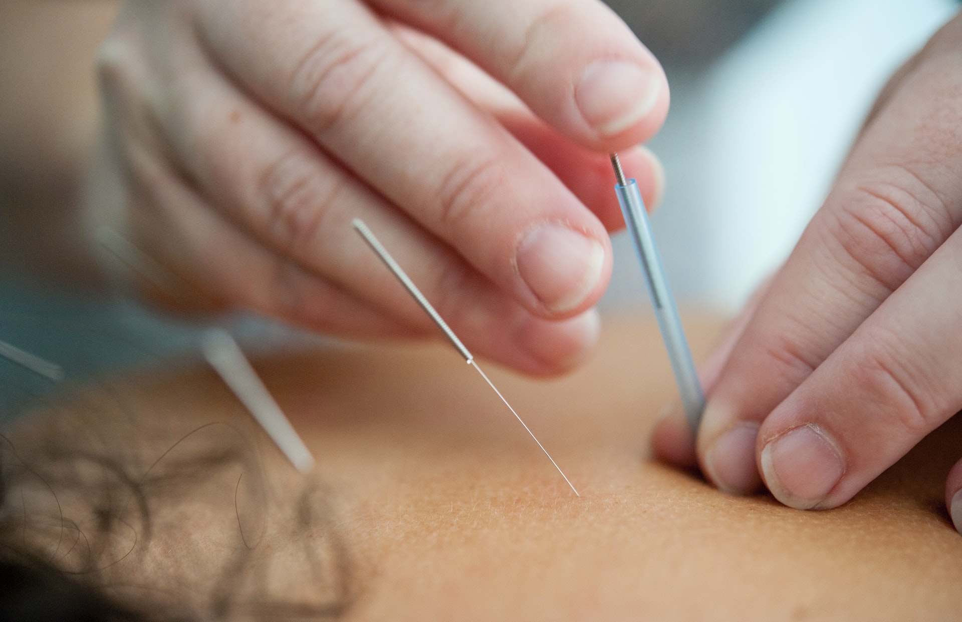 Japanese acupuncture