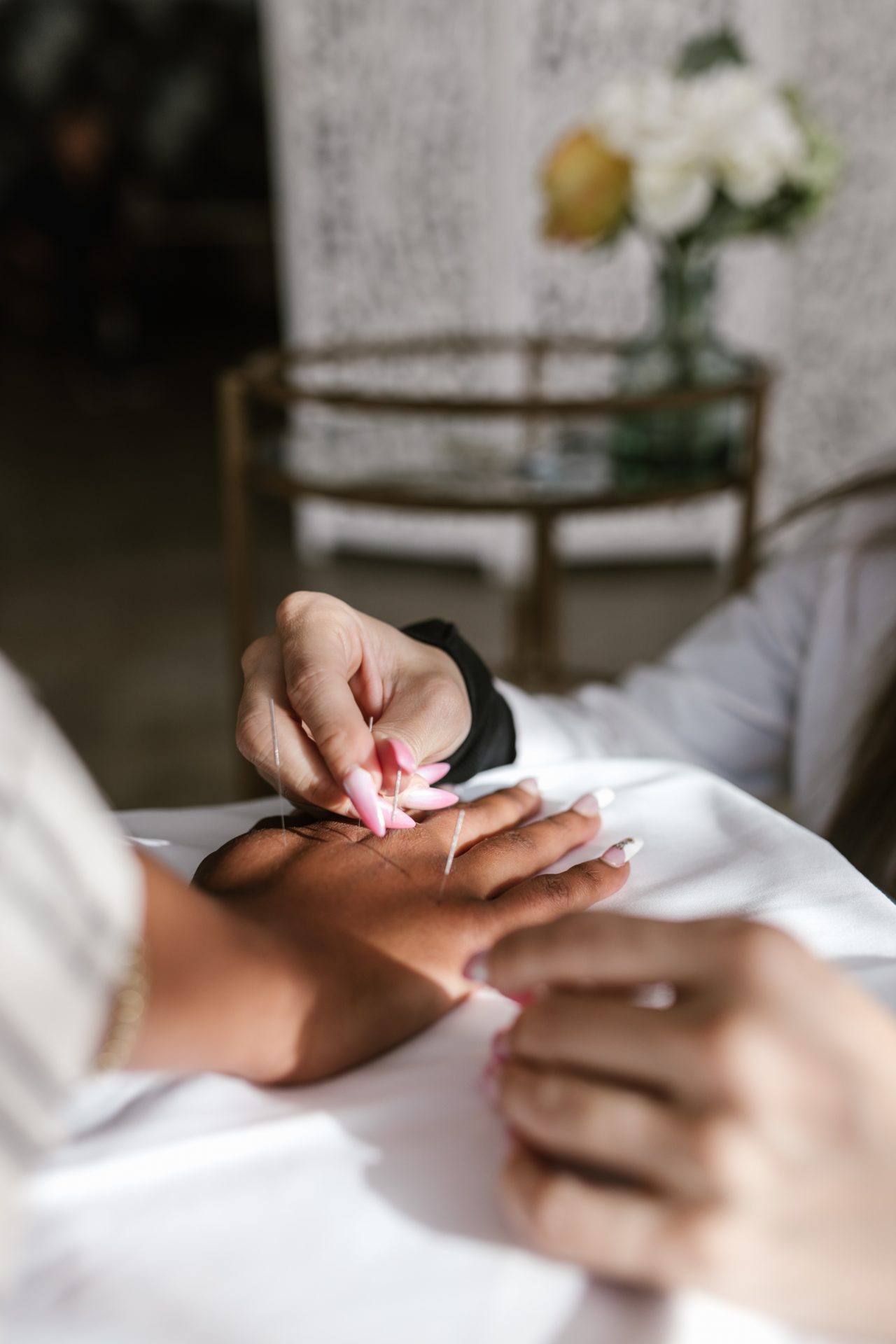 anxiety acupuncture