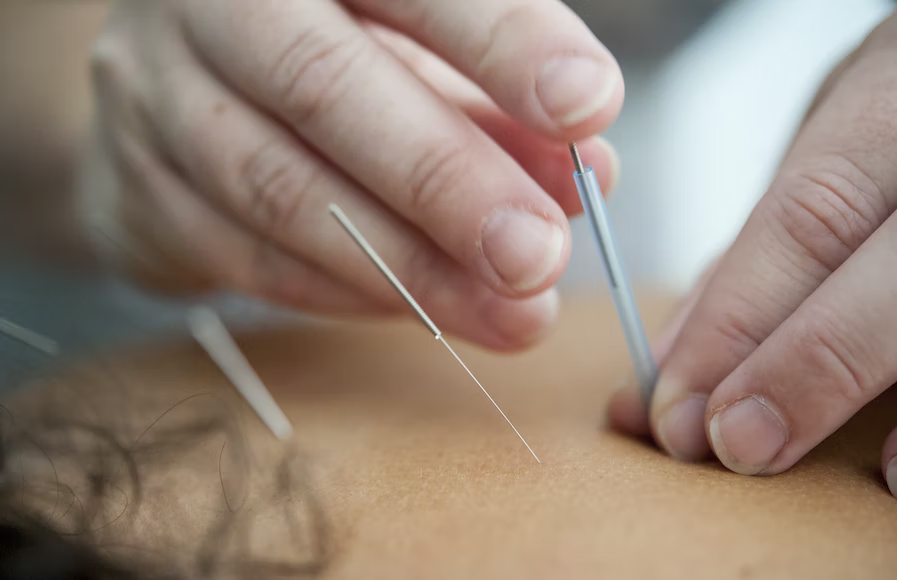 COSMETIC-ACUPUNCTURE