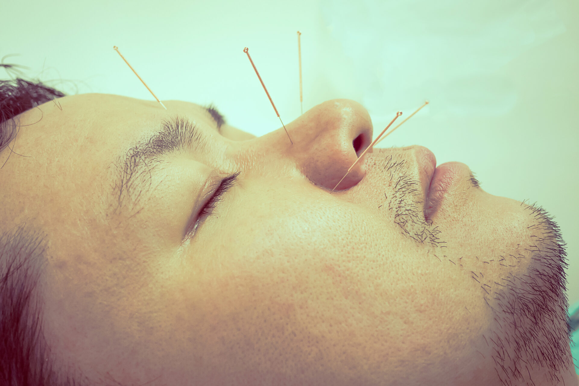 Migraine acupuncture