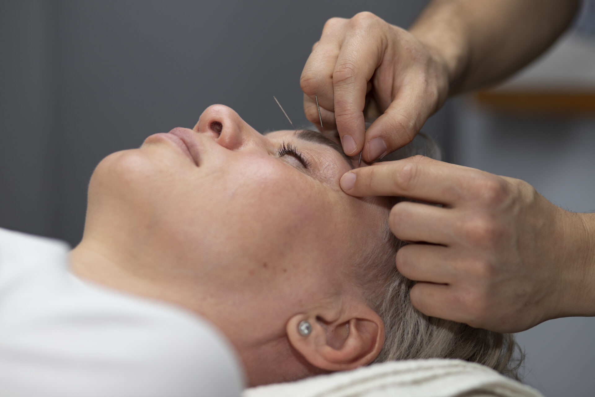 Acupuncture treatment for migraine