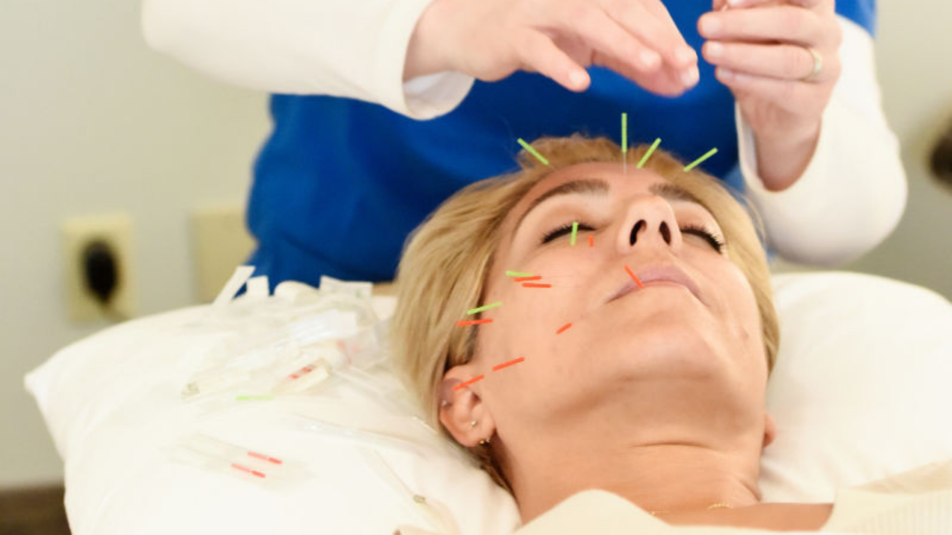 Cosmetic acupuncture