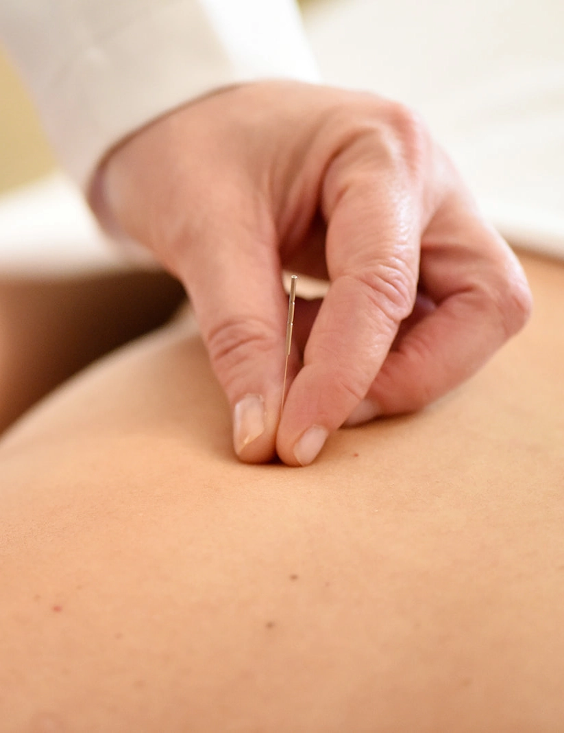 acupuncture